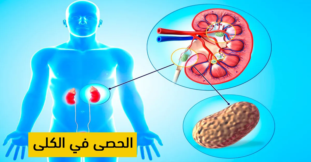 الحصى في الكلى